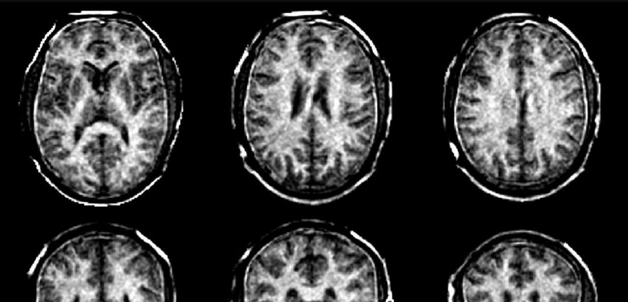 Neue MRT-Technik ermöglicht genauere Darstellung der Myelinscheiden im (Foto: ETH Zürich)